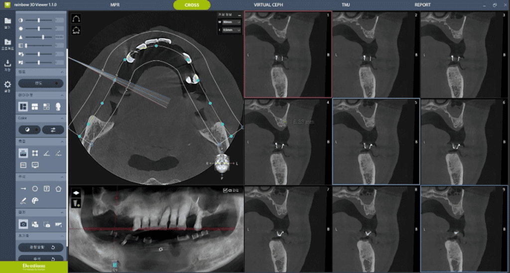 虫歯治療前の検査(X線-CT-口腔内スキャンなど)で診断する過程の画像