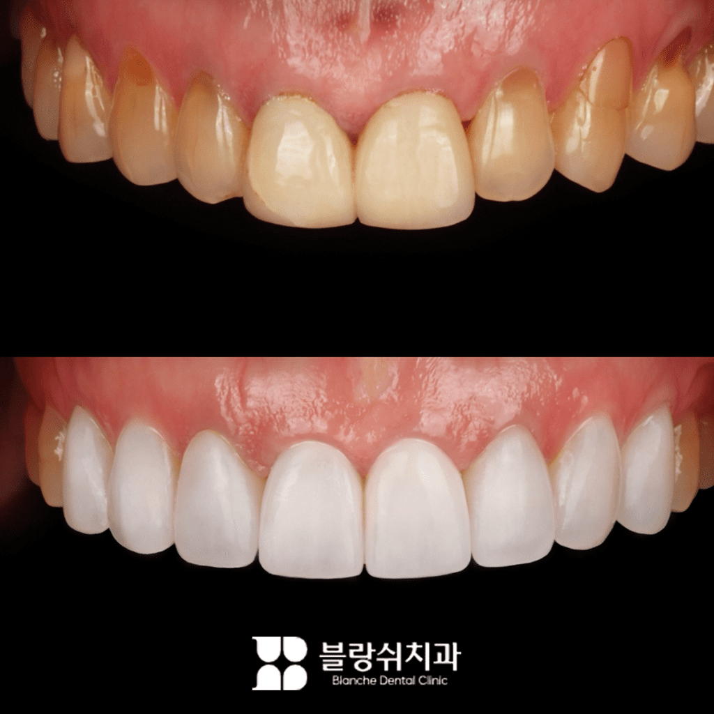 ヌルヌル無削除ラミネーター施術