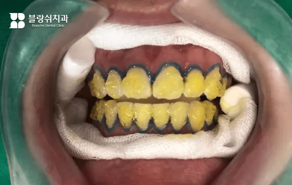 歯のホワイトニング施術中のホワイトニング剤塗布の様子、歯茎を保護した後、過酸化水素ホワイトニング剤を歯の表面に適用する段階