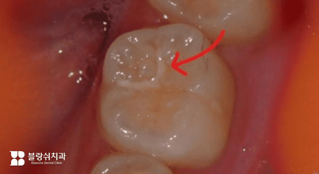 初期虫歯に行うレジン治療例画像