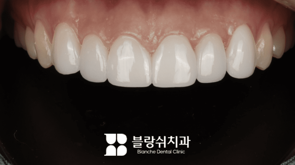 ブランシュ歯科無삭제ラミネーター写真