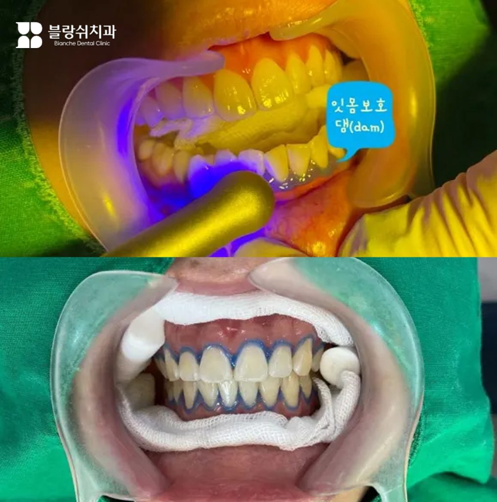 2.歯のホワイトニング施術前の歯茎保護ダム(dam)適用過程、歯茎損傷防止のための保護段階