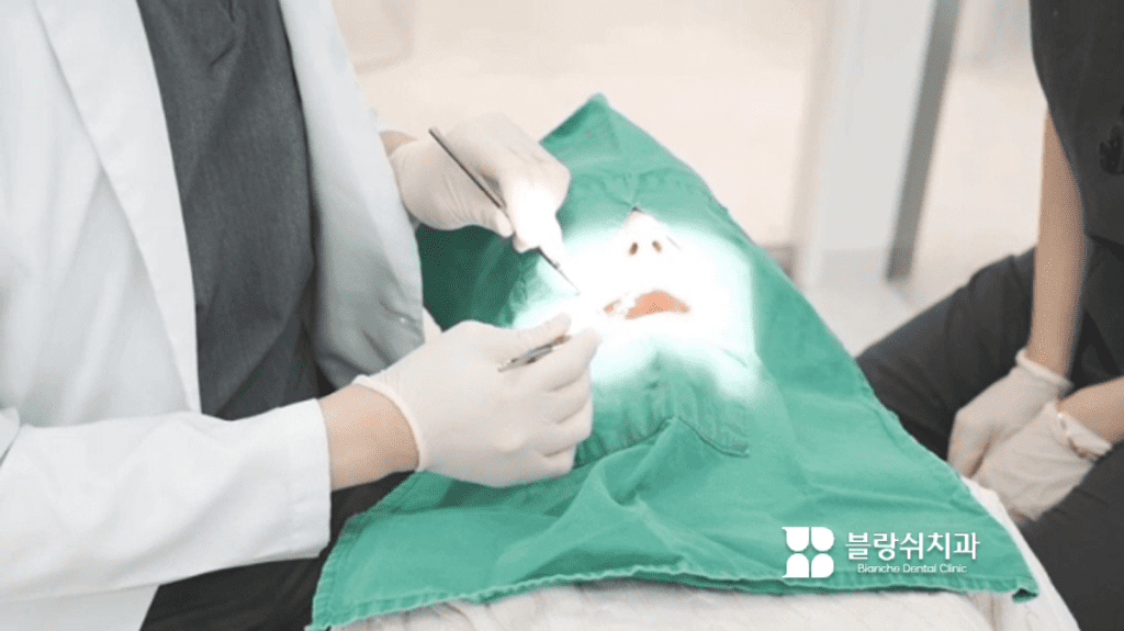 虫歯が神経まで進行した場合の神経治療(根管治療)例画像