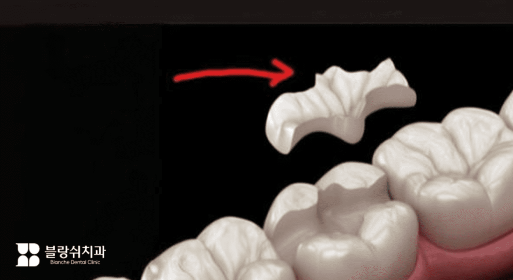 中期の虫歯治療に使用するインレイ・オンレイ補綴治療例画像