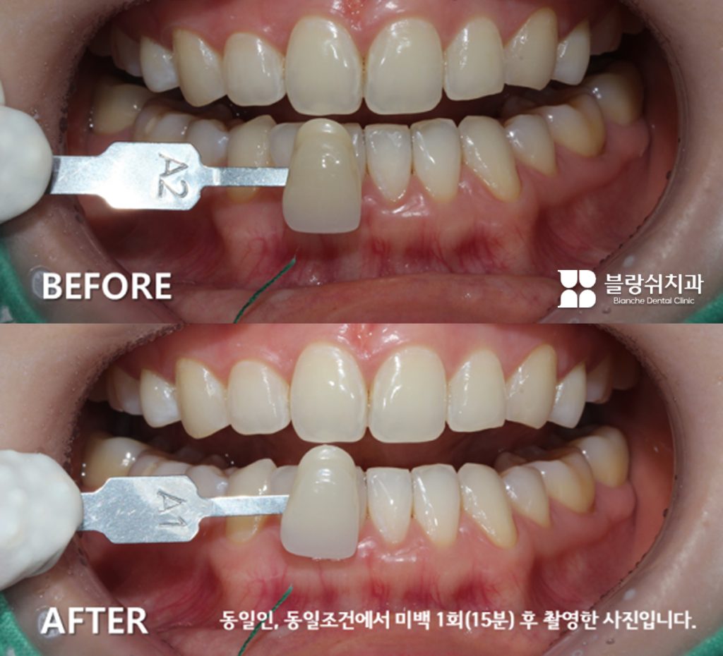 黄ばんだ歯で悩んでいた20代、歯のホワイトニング事例