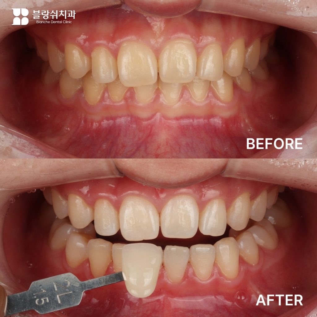 コーヒーの色素沈着で悩んでいた30代、歯のホワイトニング事例