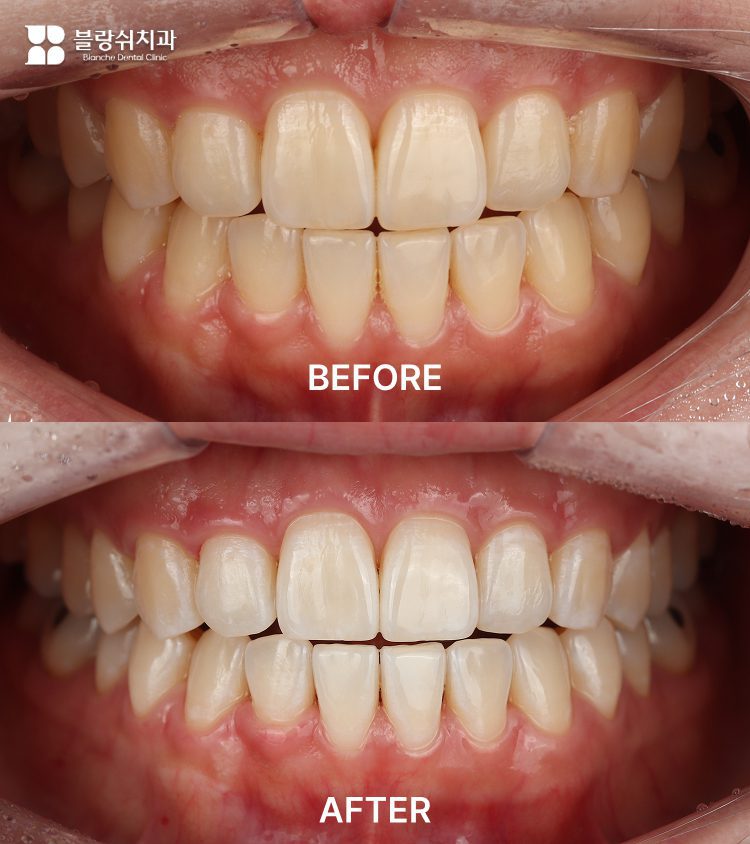 5.歯のホワイトニング1回前後の色変化をシェードガイドで比較した口腔内写真