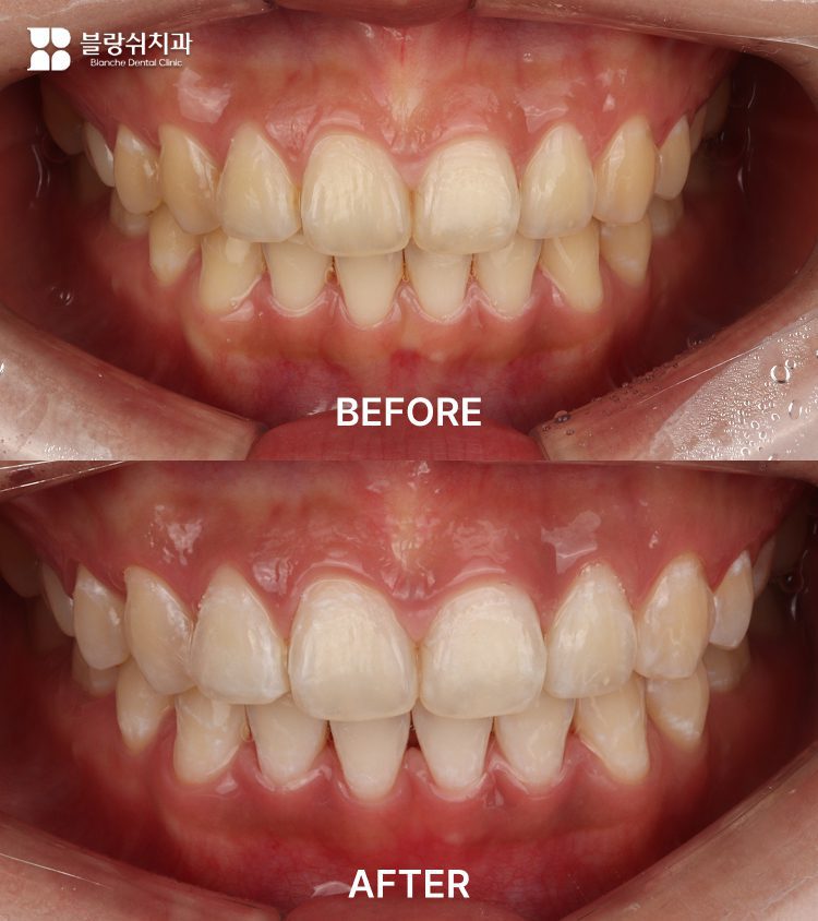 6.歯のホワイトニング前後の色変化をシェードガイドで比較した口腔内写真