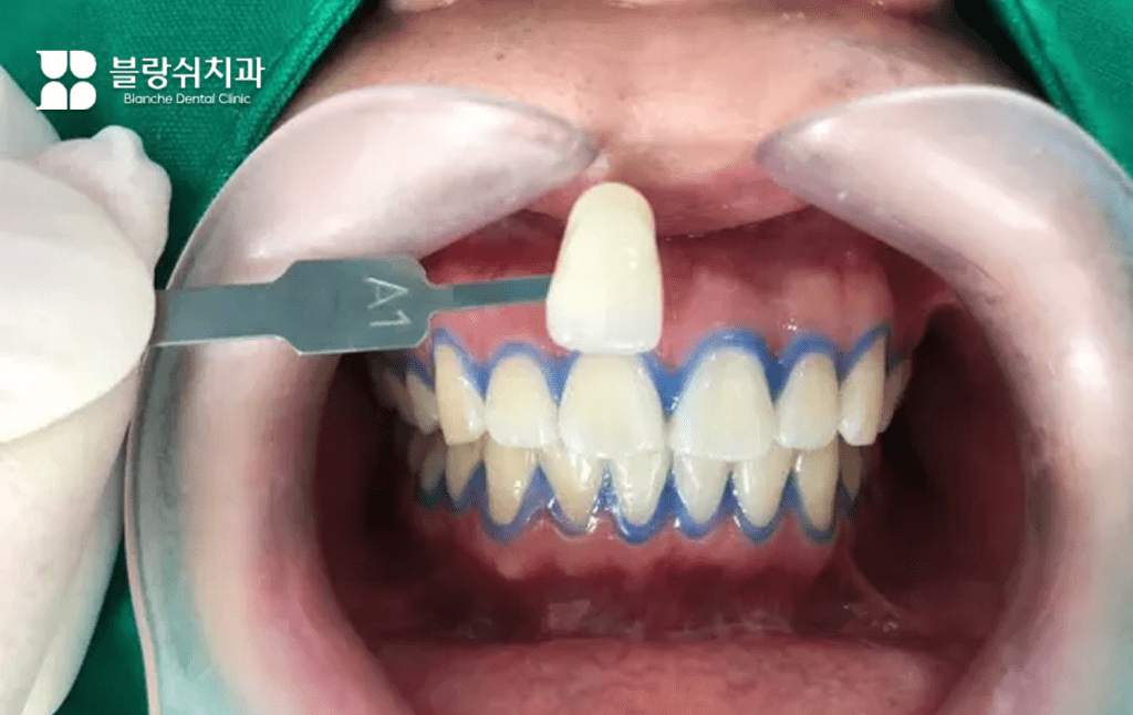 歯のホワイトニング剤除去後