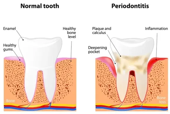 치주염이 심해 잇몸이 건강하지 않은 상태