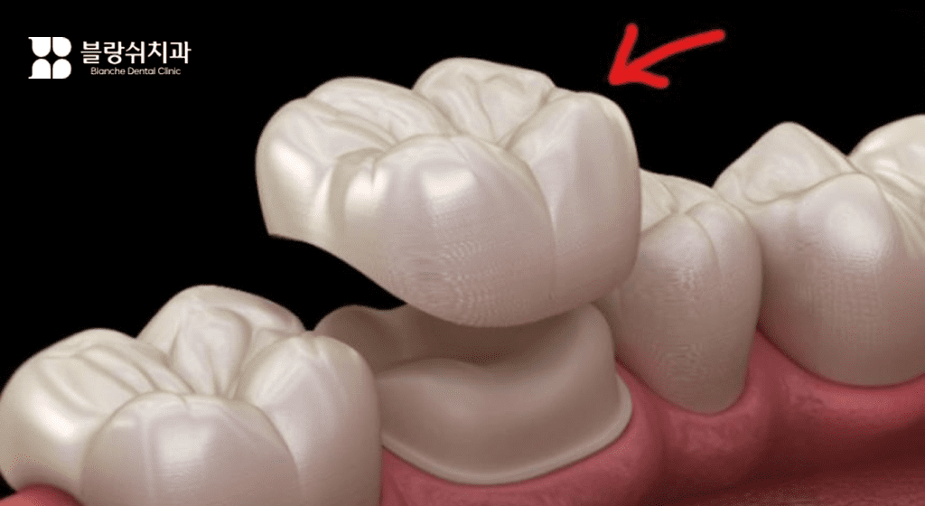 神経治療後の歯を保護するクラウン治療例画像