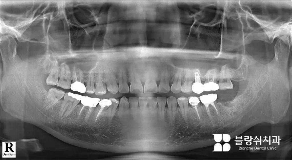 염증이 심한 어금니 발치 후 합성골 뼈이식(GBR)