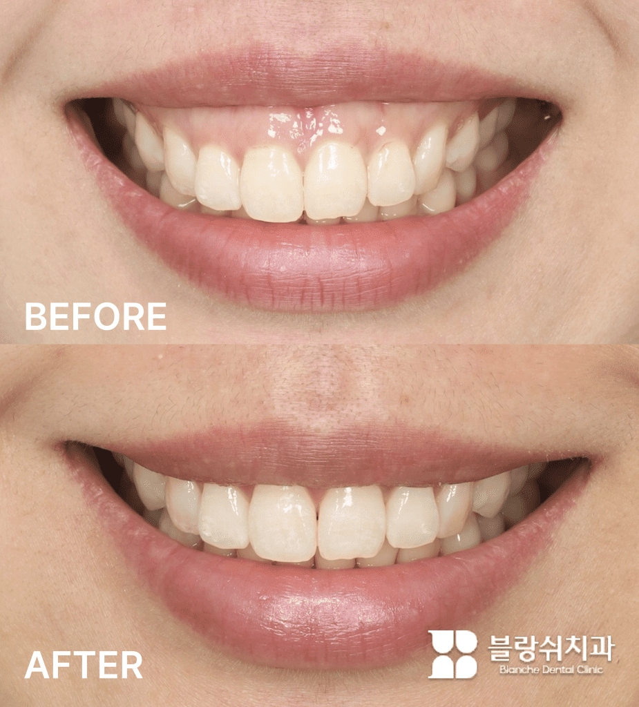 ガミースマイル改善のために口腔前庭術を行った施術前後の比較