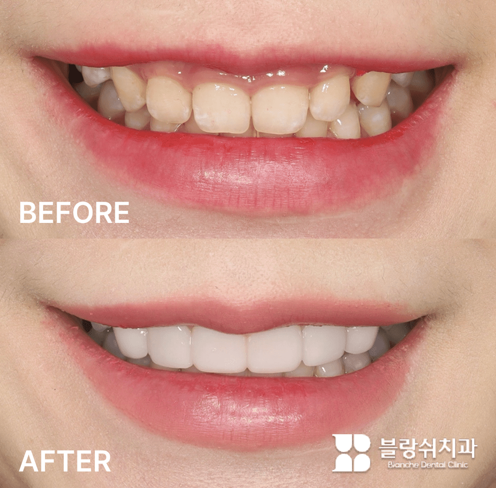 ガミースマイルと不揃いな歯列を改善したラミネート施術前後の比較