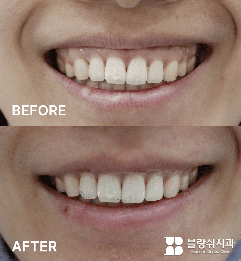 ガミースマイル緩和のための1次歯肉整形と2次ボトックス施術の比較