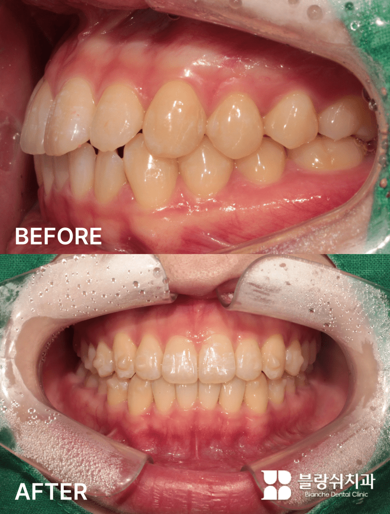 ガミースマイルと不正咬合を同時に解決した歯列矯正前後の口腔状態