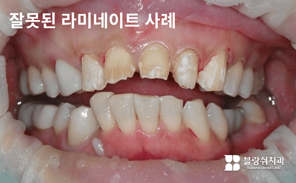 歯が過剰に削られ、ラミネート加工の副作用が深刻な状態