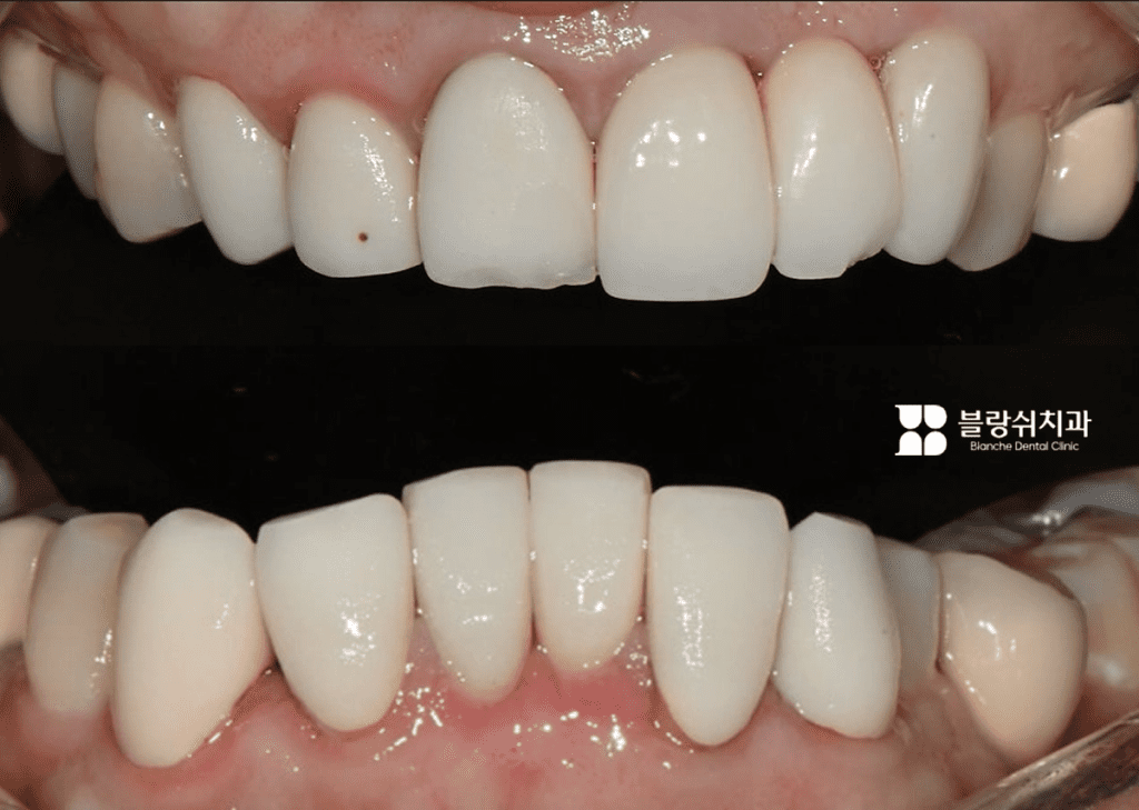 ラミネート施術の副作用事例：萌出の進行中