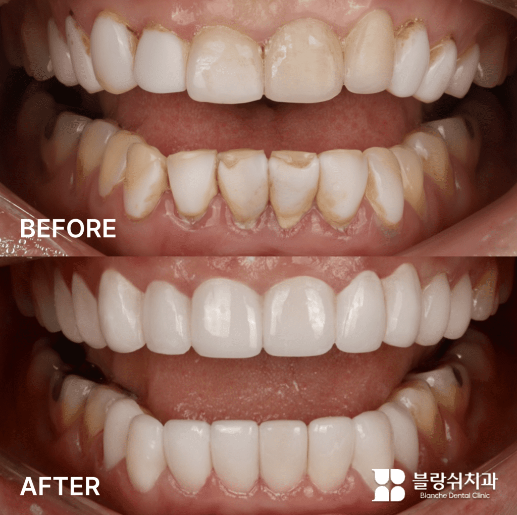 古いラミネートの経年劣化による接着剤の変色および破折