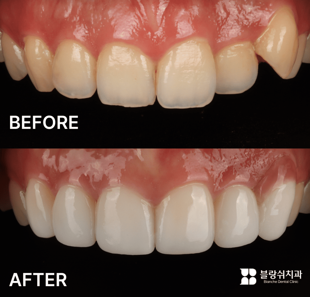 ブランシュ歯科、歯並びが良くない前歯のラミネート施術前後比較