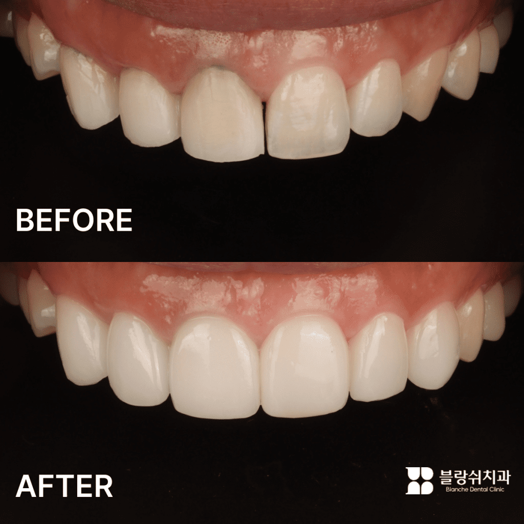 すきっ歯を自然に改善した前歯ラミネートのビフォーアフター