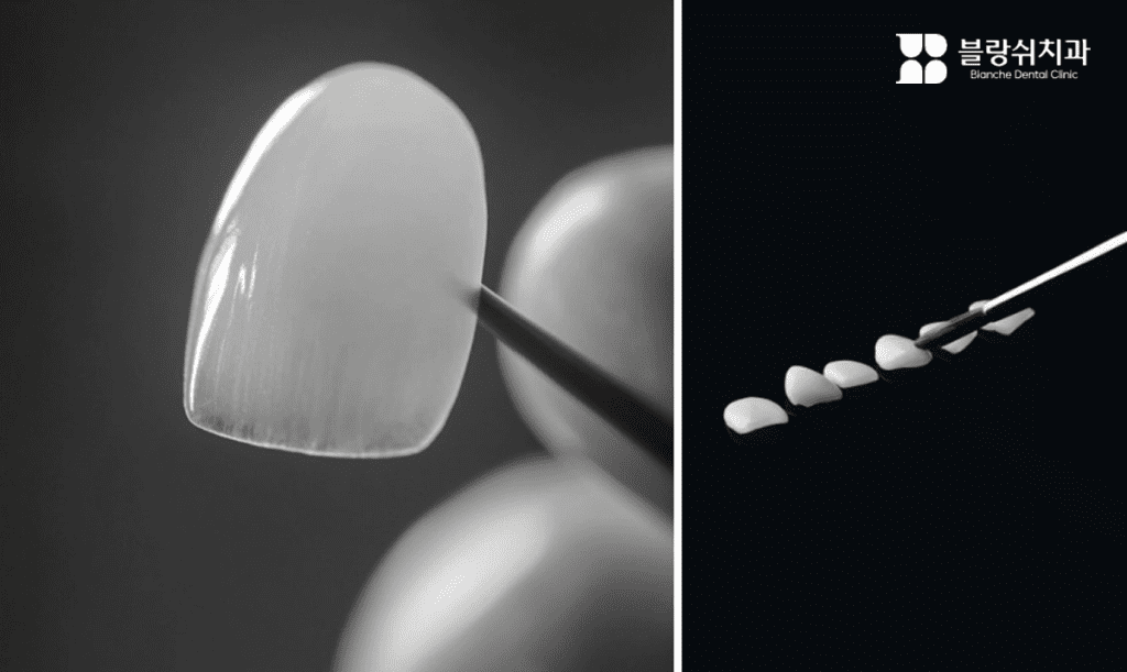 ラミネートベニアで歯の形・色・歯並びを改善する説明イメージ