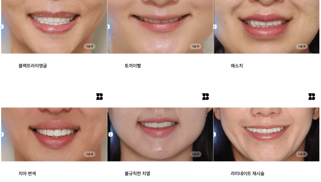 ブランシュ歯科の多様な前歯ラミネート施術ケース