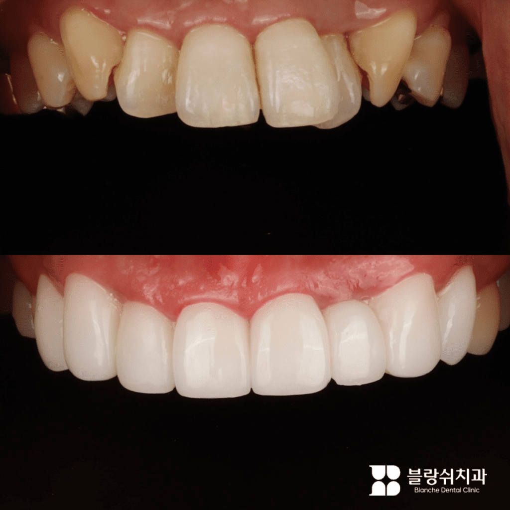 ラミネートの副作用の心配がないブランシュ歯科の施術前後の比較