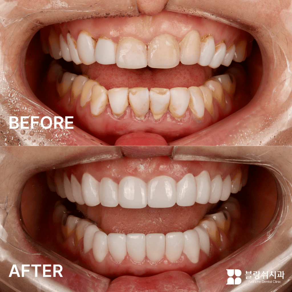 激しい変色と不規則な歯並びを改善した前歯ラミネートのビフォーアフター