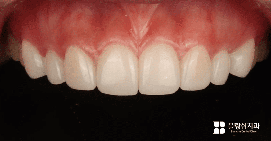 自然で透明感のある前歯ラミネート施術後の様子