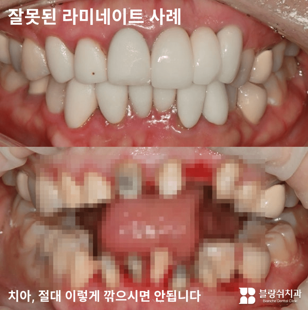 ラミネートの副作用前後の比較と歯の削除注意のご案内