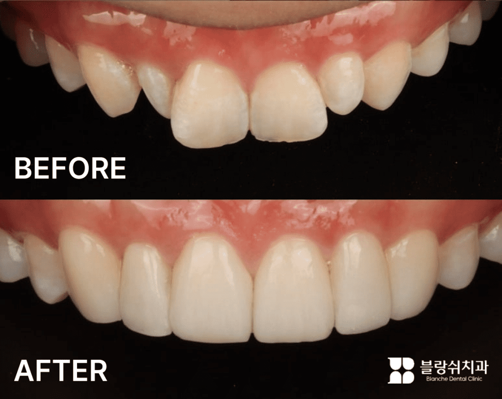 うさぎ歯のラミネートベニア前後比較事例イメージ（うさぎ歯・矮小歯・変色の改善）