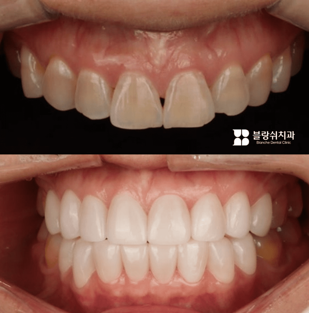 歯の隙間や変色を改善した無削削りラミネート治療前後