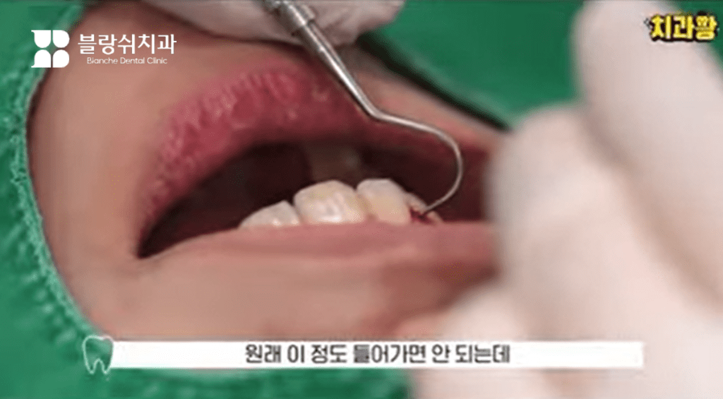 라미네이트 단점 충치