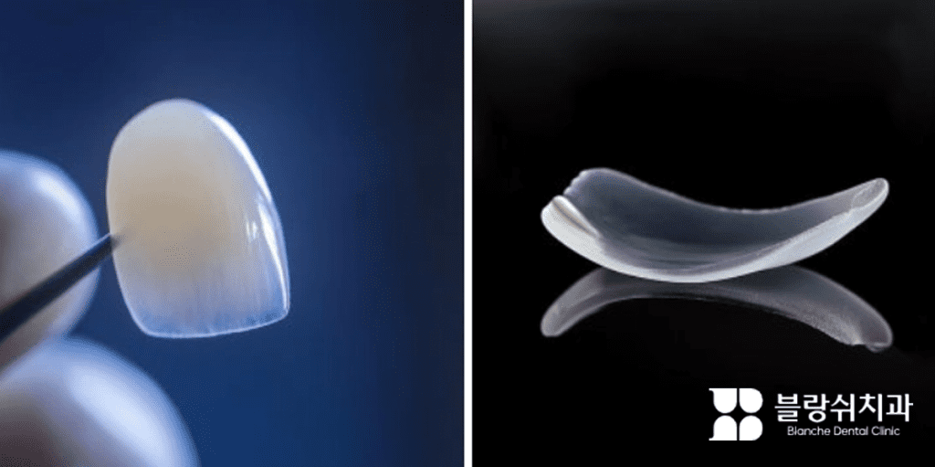 黒い背景の上に反射された薄くて透明な削らないラミネートべニア