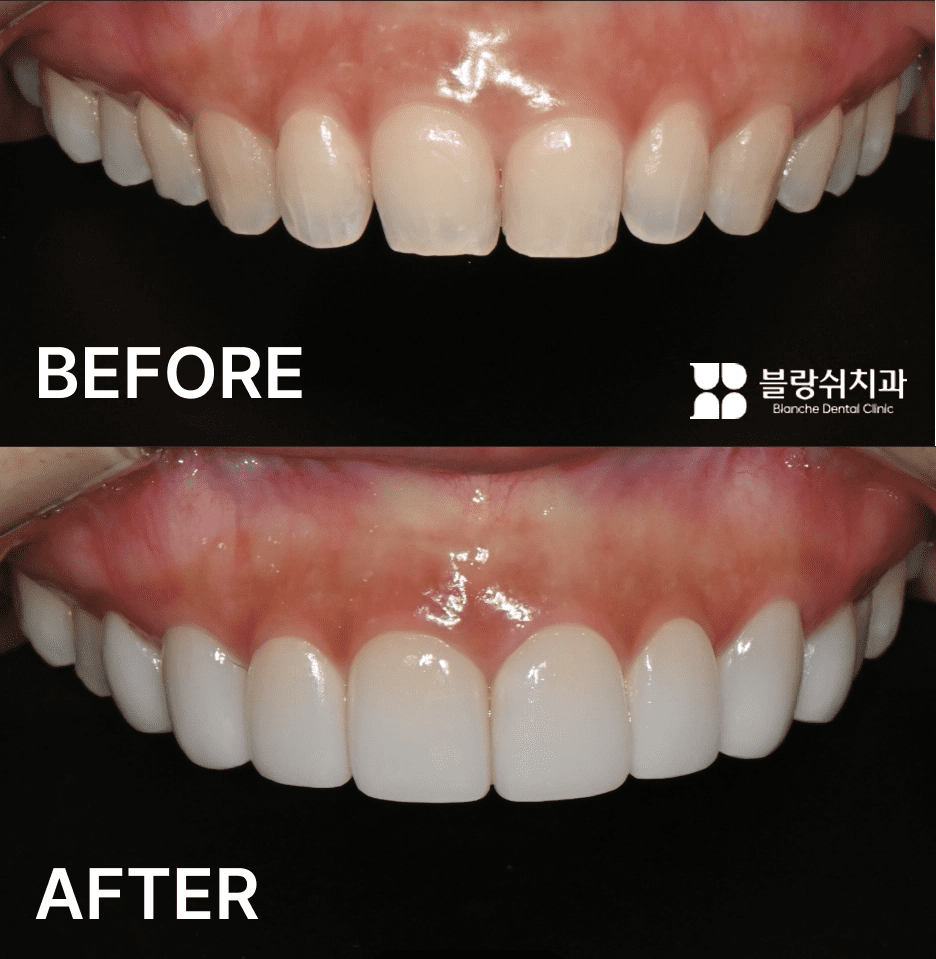 上顎奥歯出っ歯ラミネート前後正面比較