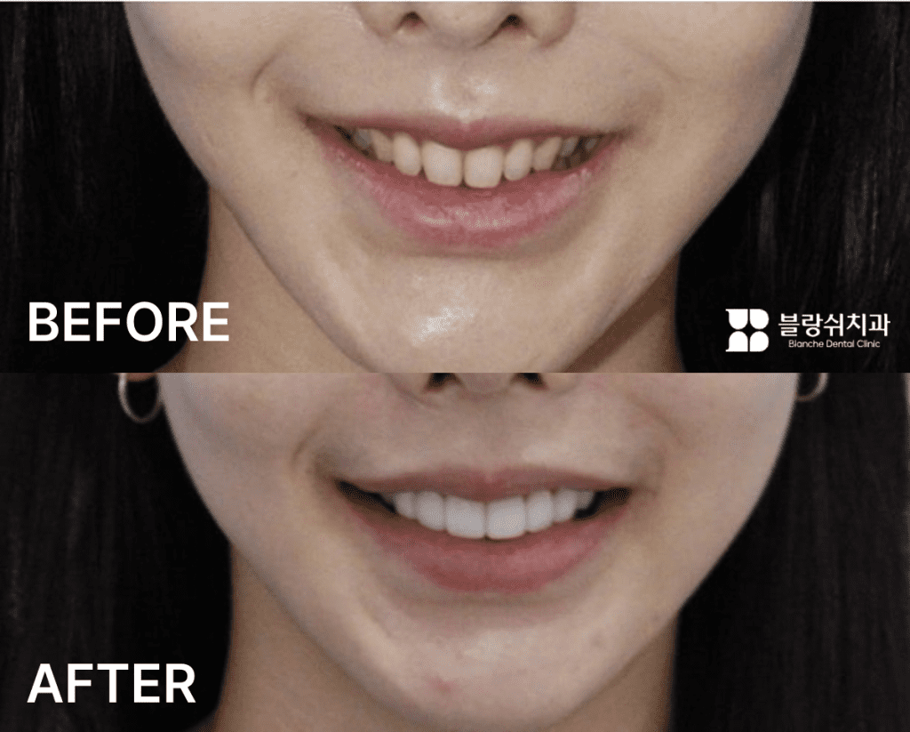 上顎出っ歯ラミネート前後の歯形の比較