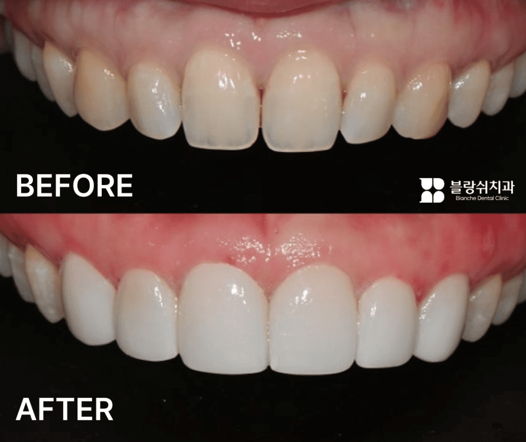 出っ歯ラミネート前後の笑顔の変化比較
