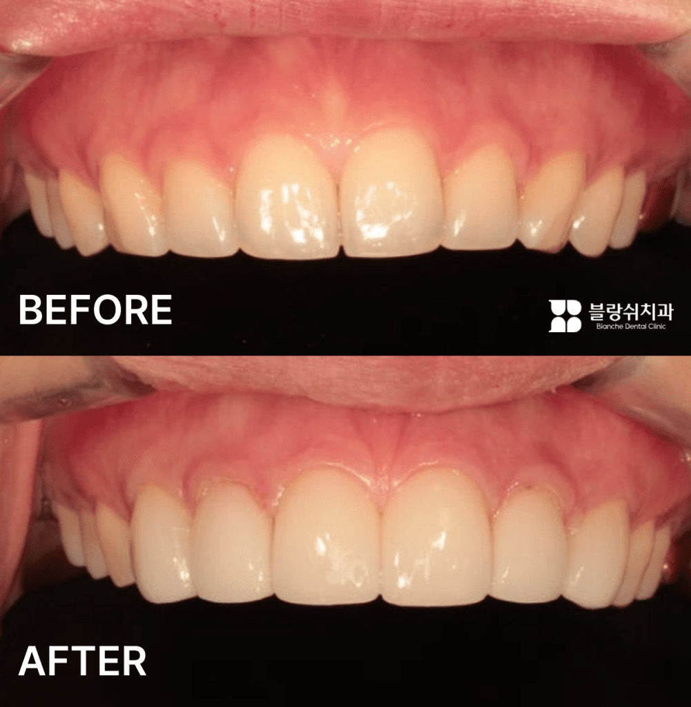 上顎全体の出っ歯ラミネート加工の施術前後の比較