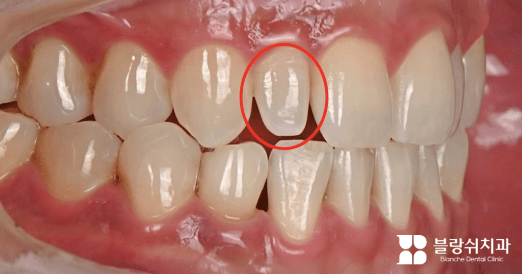 矮小歯の症状により、歯と歯の間が開いて前歯の大きさが小さくなる