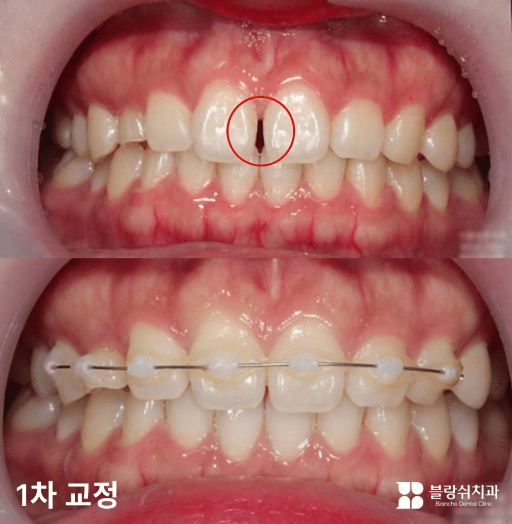 矮小歯列矯正治療前後の前歯の隙間を改善したプロセス