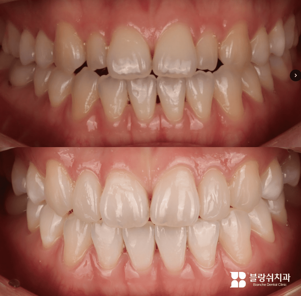 歯並びと色を改善した無削りラミネート加工の施術前と後