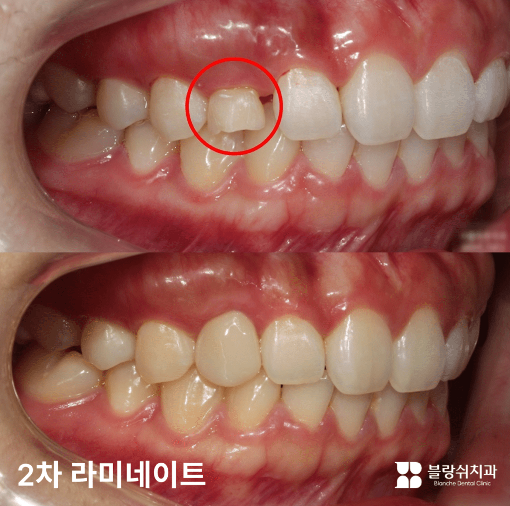 矮小歯ラミネート加工で小さくて変形した歯の大きさを復元した前後