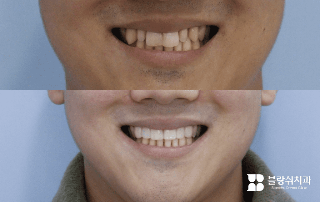 矮小歯のラミネート加工前後、明るく均一な歯並びで変化した笑顔