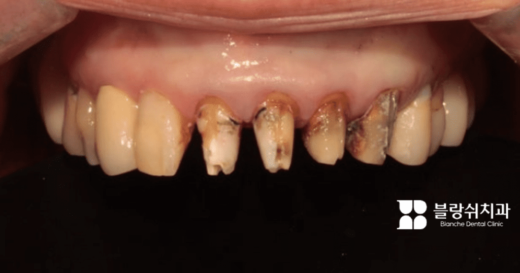 矮小歯の削除の副作用で歯が変色し、損傷を受けた事例