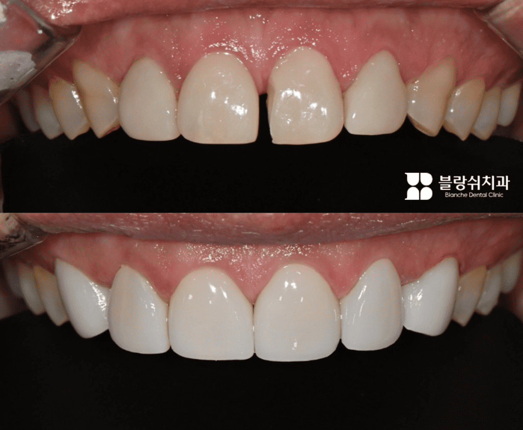 広がった前歯を無削削りラミネートで整然と改善した前後