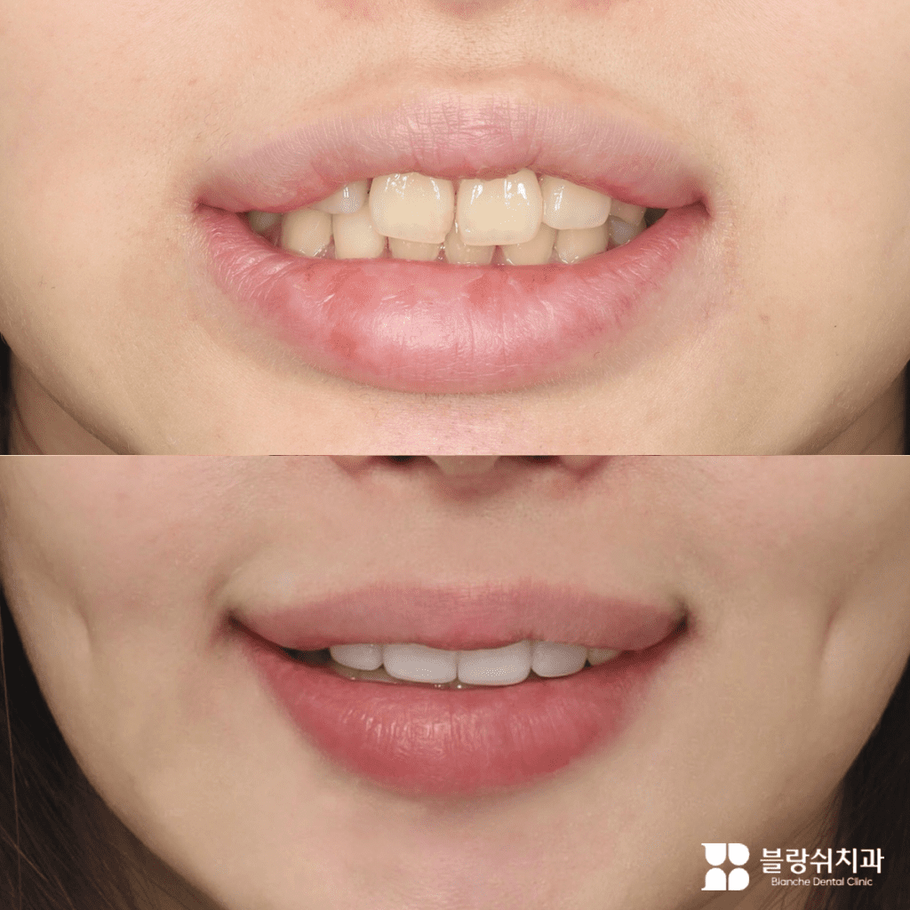 無削削りラミネート加工の施術前後の出っ歯(うさぎ歯)と変色した歯の比較前面