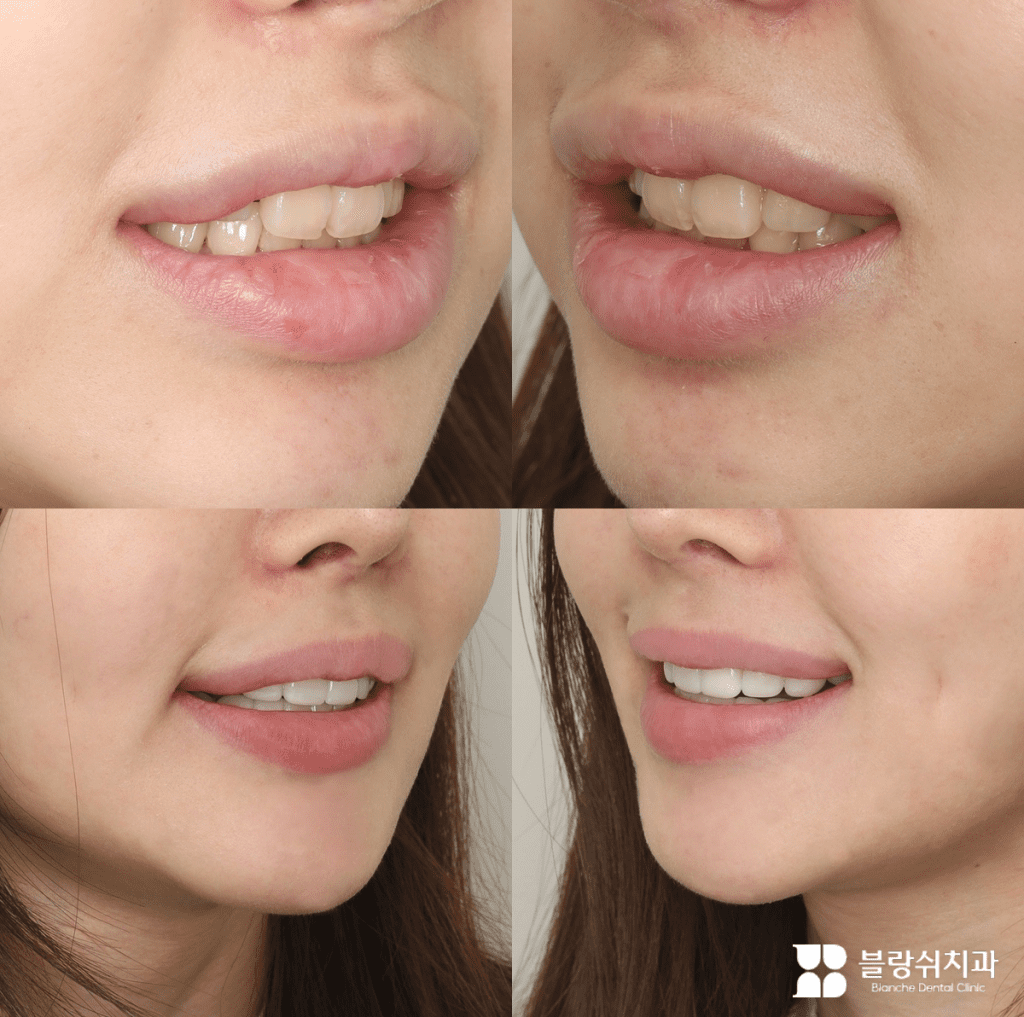 笑顔のウサギの歯の無削除ラミネート加工の施術前後の唇の変化