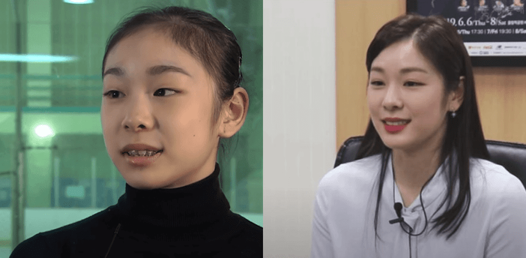 김연아 돌출입 교정