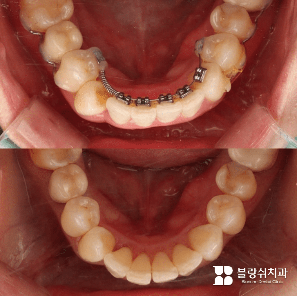 설측교정 2D 교정